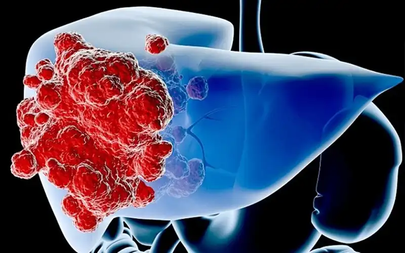 Ung thư biểu mô tế bào gan là gì?