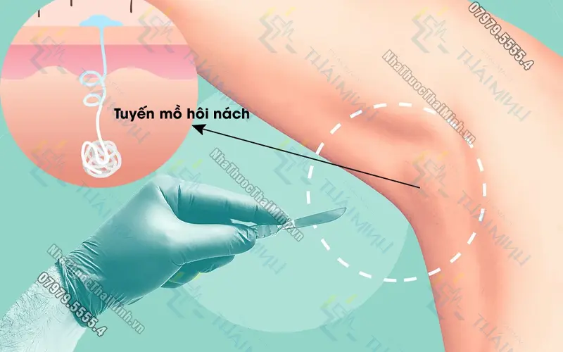 Mẹo trị hôi nách dân gian hiệu quả nhanh và an toàn