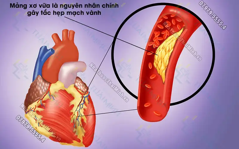 Hẹp mạch vành là gì? Triệu chứng, phân loại và mức độ nguy hiểm