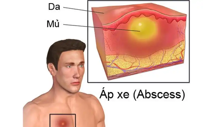 Những cách điều trị áp xe tại nhà hiệu quả không nên bỏ qua