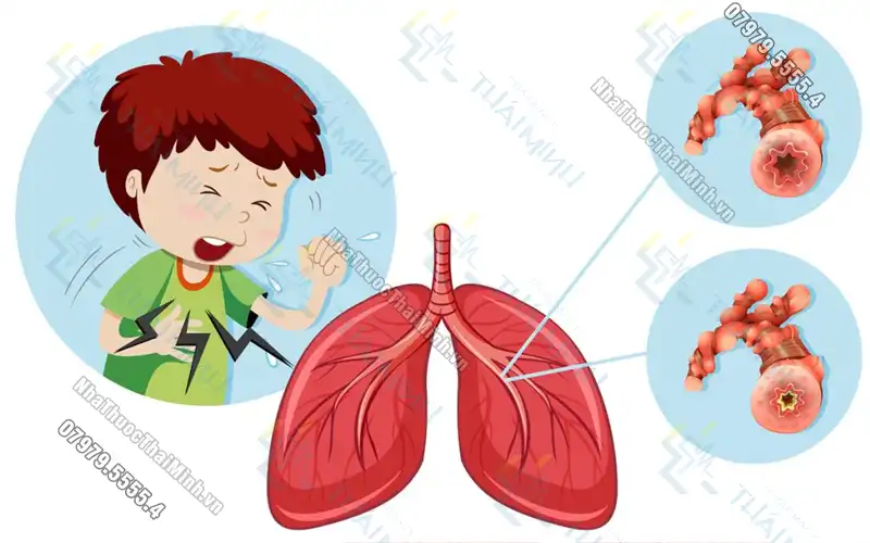 Mách bạn mẹo dân gian chữa viêm phổi cho trẻ