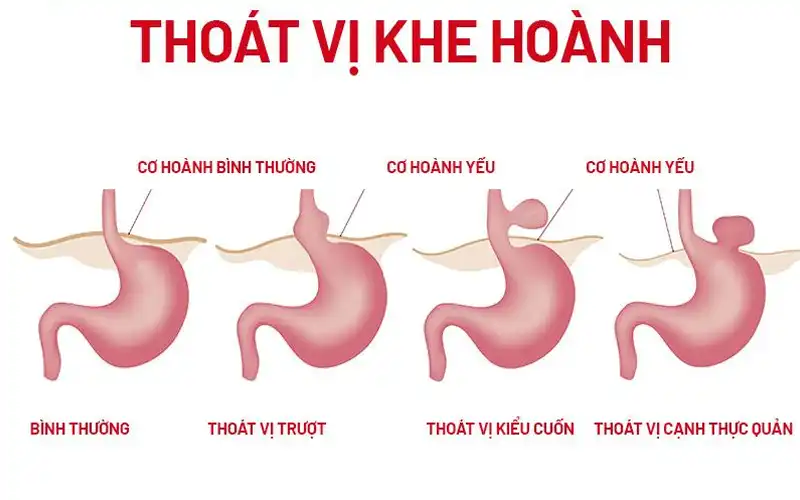 Thoát vị hoành ở người lớn có biểu hiện gì?