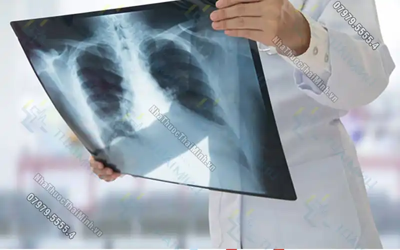 Chụp X-quang phổi là gì? Chụp X quang phổi và tất cả những điều cần biết