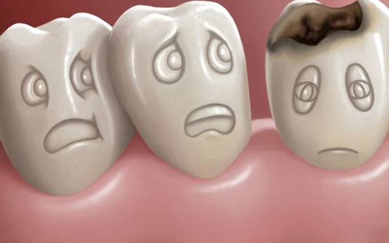 Răng số 8 bị sâu vỡ: Nguyên nhân và cách điều trị