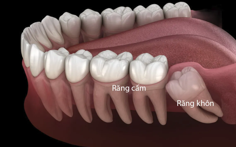 Cách phân biệt răng cấm và răng khôn là gì?