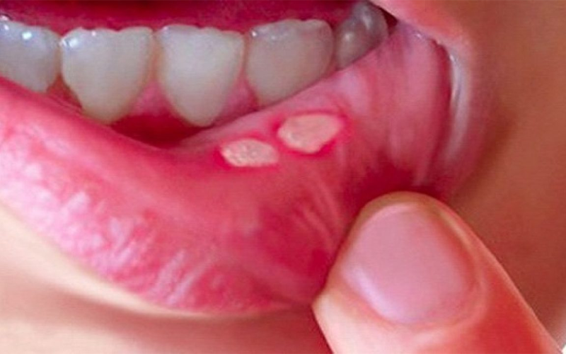 Loét áp tơ miệng là gì? Những triệu chứng nổi trội bệnh loét áp tơ miệng