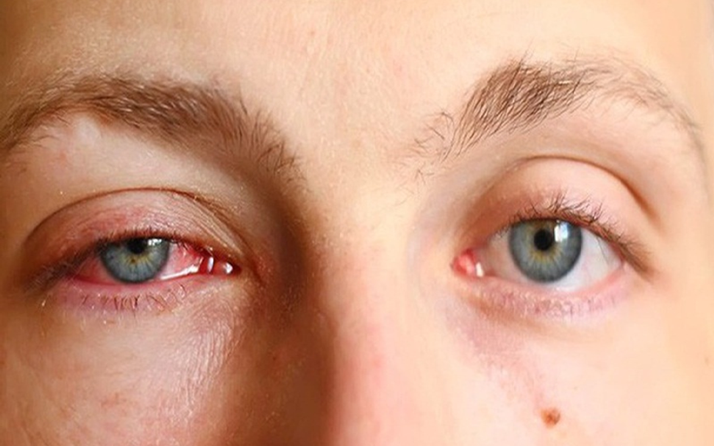 Thắc mắc: Bệnh đau mắt đỏ lây lan như thế nào và cách phòng ngừa