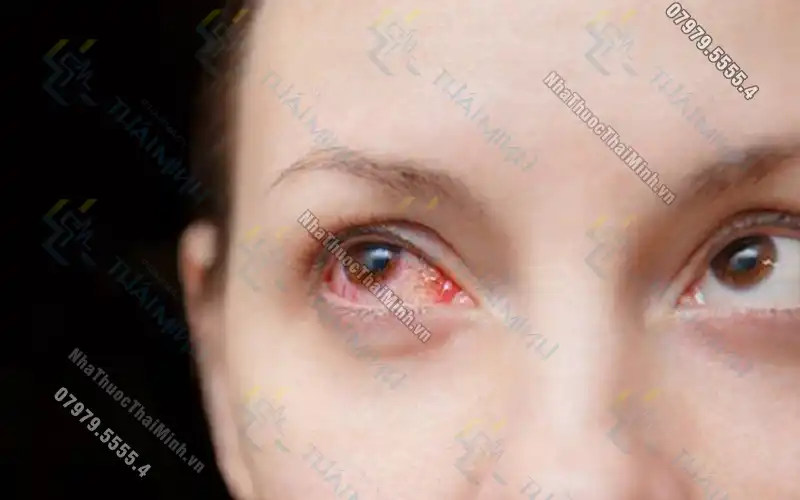 Đau mắt đỏ điều trị như thế nào? Phương pháp phòng ngừa đau mắt đỏ hiệu quả