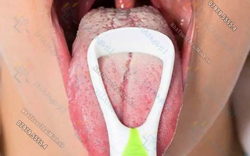 Lưỡi bị nứt là tình trạng gì? Nguyên nhân và cách điều trị như thế nào?