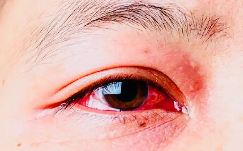 Góc giải đáp: Đau mắt đỏ có nguy hiểm không?
