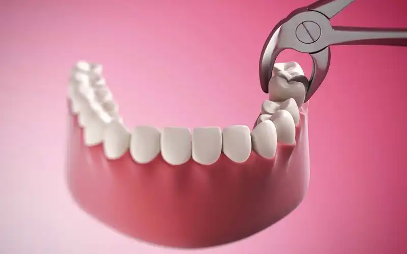 Khoảng cách giữa 2 lần nhổ răng khôn tối thiểu là bao lâu?