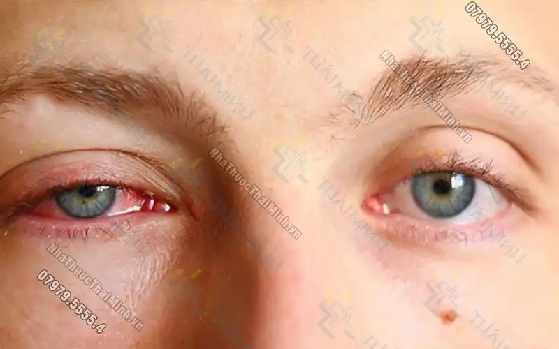 Nguyên nhân và cách giảm đau mắt đỏ sưng húp hiệu quả