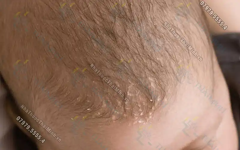 Bệnh vảy nến da đầu: Nguyên nhân, triệu chứng