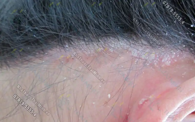 Bệnh vảy nến da đầu: Nguyên nhân, triệu chứng