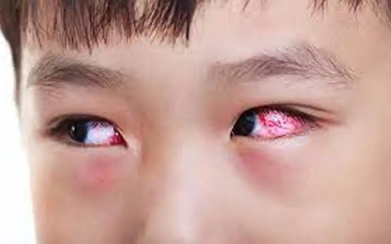 Một số cách phòng ngừa bệnh đau mắt đỏ hiệu quả
