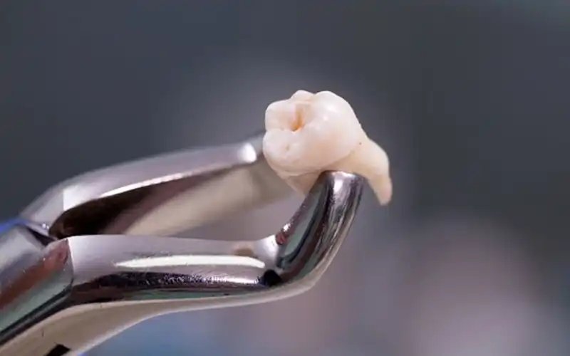 Góc thắc mắc: Nhổ răng khôn có cần khâu không?