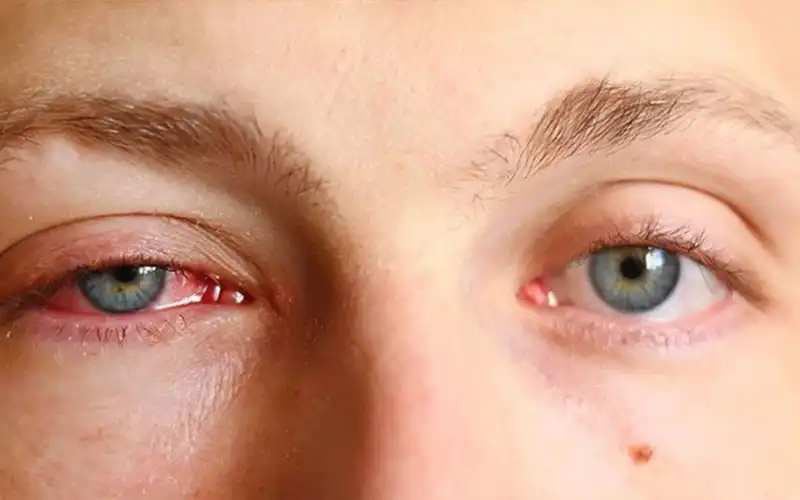 Đau mắt đỏ điều trị như thế nào? Phương pháp phòng ngừa đau mắt đỏ hiệu quả