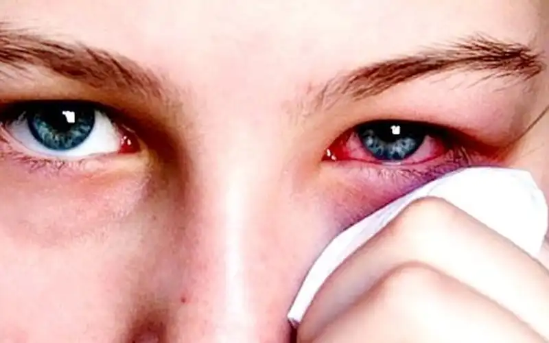 Góc giải đáp: Nhìn người đau mắt đỏ có bị lây không?